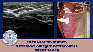 External Oblique Intercostal Ultrasound Guided Nerve Block [upl. by Mllly311]