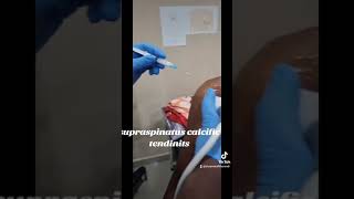 ultrasound guided shoulder injection [upl. by Sucramel]