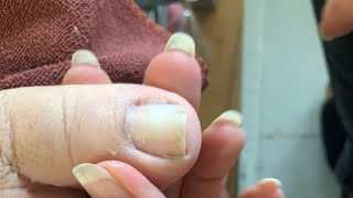 Clean the Skin and remove the corner of the nail532 [upl. by Zetniuq]