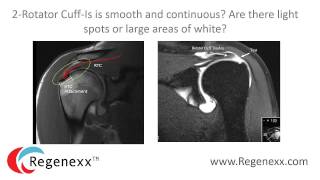 How to read your shoulder MRI with Dr Centeno of Regenexx [upl. by Gloriane]