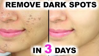 In 3 DAYS  Remove DARK SPOTS BLACK SPOTS amp ACNE SCARS  Anaysa [upl. by Secor500]