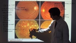 Retinopatía Diabética  Tipos y Tratamiento  Patología Ocular [upl. by Roosnam]