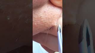 Chin Hair Plucking  PCOS facialhair satisfyingvideo removefacialhair [upl. by Oshinski377]