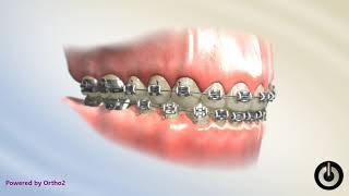 Decalcification  Dental Braces  Temecula Valley CA [upl. by Alisha]