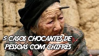 5 CASOS CHOCANTES DE PESSOAS COM CHIFRES [upl. by Tneciv90]