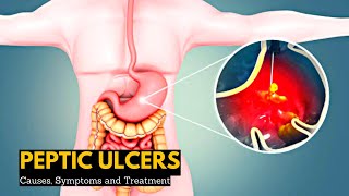 Peptic Ulcers Causes Signs and Symptoms Diagnosis and Treatment [upl. by Merridie474]