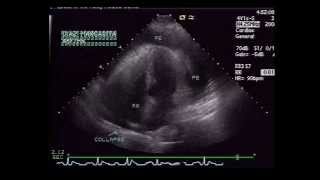 Pericardial Effusion with RA Collapse [upl. by Swenson]