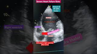 Pacemaker ICD Lead in Right Ventricle for weak Heart l पेसमेकर l echo heartfailure shorts [upl. by Atteynod242]