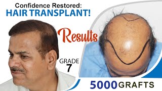 5000 Grafts Hair Transplant Results in Grade 7  Results  Dr Suneet Soni  Medispa India Cost [upl. by Valleau]