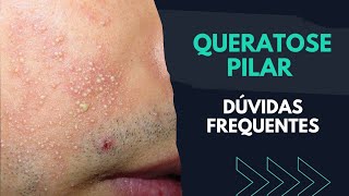 QUERATOSE PILAR Dúvidas Frequentes  Especialista Responde [upl. by Nitsoj]