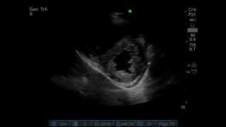 Right ventricular pressure overload Dsign on Echo PSAX view [upl. by Shakti266]