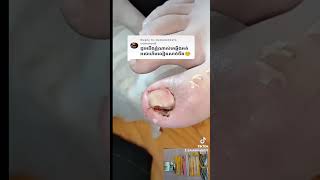 He stored too much cuticle under his toenail nail​​​ asmr fyp ear shorts viral wax [upl. by Nuajed]