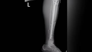 CLAVO CENTROMEDULAR PARA CORRECCIÓN QUIRÚRGICA DE TIBIA ROTA [upl. by Selhorst424]