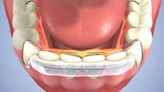 Hawley Spring Aligner Naidu Orthodontics [upl. by Season688]