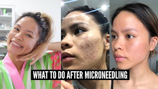 12 Important Microneedling Aftercare Tips [upl. by Kcirdez]