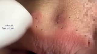 Acne on Forehead  Blackhead Removal on his forehead  Acne Treatment removeblackhead [upl. by Clim]