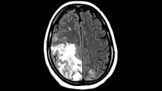 Hemorrhagic Infarct Secondary to Dural Sinus Thrombosis [upl. by Blackstock679]