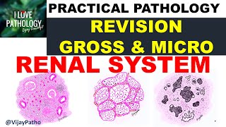 Practical Pathology Renal system Chronic pyelonephritis RCC amp Wilms tumor [upl. by Osy520]