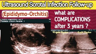 Chronic Scrotal Infection  Complications  Male Infertility  Epididymo Orchitis [upl. by Aldwin892]