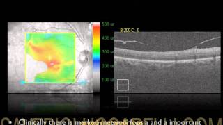 OCT IN EPIRETINAL DISEASE LE MEMBRANE EPIRETINICHE STUDIATE CON OCT MACULARE [upl. by Servetnick]