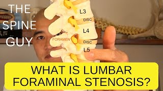 What is Lumbar Foraminal Stenosis [upl. by Thill]