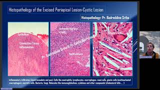 Cystic Lesion of Endodontic Origin  17 Years After  Prof Latifa Berrezouga [upl. by Aneeres]