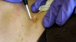 Dorset Somerset Bristol and Southwest England Mole Removal Surgery  cosmetic radiosurgery [upl. by Ulda945]