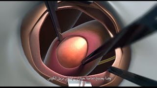 Inguinal Hernia Repair [upl. by Naes]