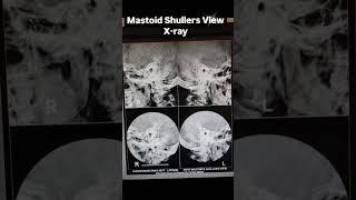 Mastoid Shullers View XRay shorts radiology xray trending viral paramedicalcourses [upl. by Einama194]