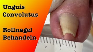 Unguis Convolututs Rollnagel Behandlung 1  podologinandrea [upl. by Alyat]