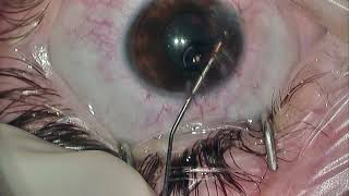 Iris reconstruction in a phakic patient [upl. by Capwell]