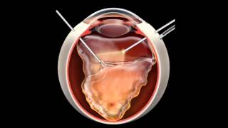 Retinal Detachment  Signs Symptoms and Treatment [upl. by Acisset725]