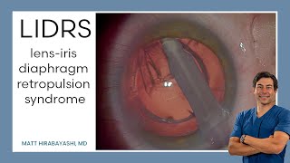 LIDRS lensiris diaphragm retropulsion syndrome Explanation and Demonstration [upl. by Notsuj]