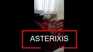 Asterixis  Flapping Tremor  Liver Flap [upl. by Notlih382]