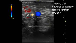 Tracking the great saphenous vein to the saphenofemoral junction Color Doppler ultrasound video [upl. by Jemie]