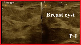 Breast cyst  Infected subareolar cyst in right breast  Amader hospital  Breast Report  Part  1 [upl. by Balliett114]