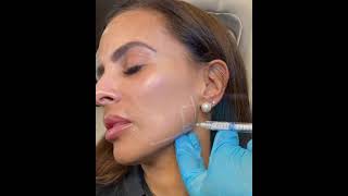 Jawline contouring filler [upl. by Greggs643]