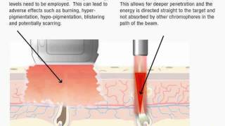 True Laser Hair Removal Vs IPL [upl. by Goldie241]