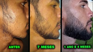 1 ANO E 4 MESES USANDO MINOXIDIL Pant Kirkland e Dom Pelo [upl. by Nap895]