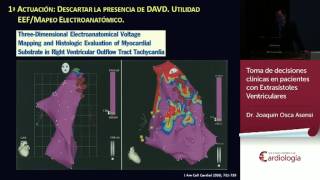 Toma de decisiones clínicas en pacientes con Extrasístoles Ventriculares [upl. by Ragse934]