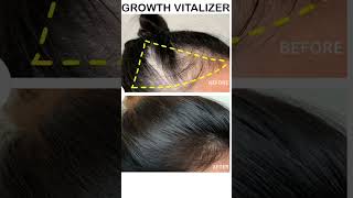 FORT Minoxidil Hair Growth Spray  Hair Tonic for Hair Care and Hair Growth  Premium Hair Care [upl. by Novick]