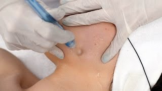 Oxybrazja  peeling tlenowo wodny [upl. by Kedezihclem]