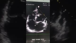 Markedly impaired LV systolic function with large apical thrombus [upl. by Akenit]