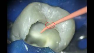 25 Acute Apical Periodontitis RCT [upl. by Gerhan]