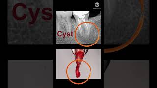 Cyst removal [upl. by Liahus]