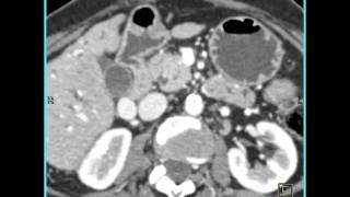 Abdomen Pancreas Staging of pancreatic cancerAnalysis of arterial and venous structures5 of 11 [upl. by Giulio]