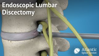 Endoscopic Lumbar Discectomy [upl. by Trevlac]