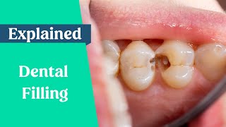 Dental Fillings Explained [upl. by Vanden]