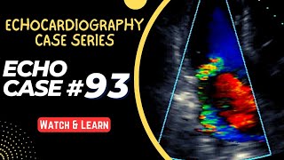 ECHO CASE 93  Echocardiography for Beginners  Echocardiogram Interpretation  2D Echo Basics [upl. by Einahpets331]