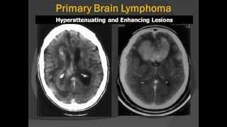 Corpus Callosum Primary CNS Lymphoma PCNSL RadiologicPathologic Correlation [upl. by Mendie]